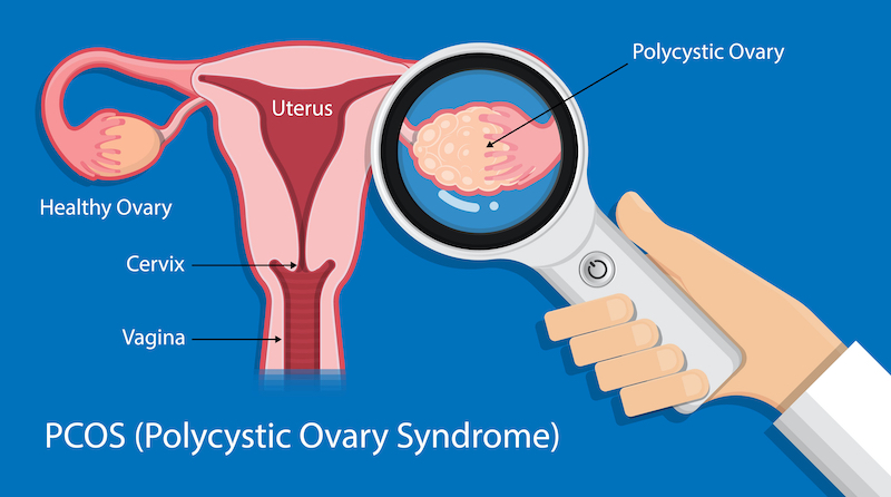 Diagram explaining the difference between a healthy ovary and a polycystic ovary in those living with pcos