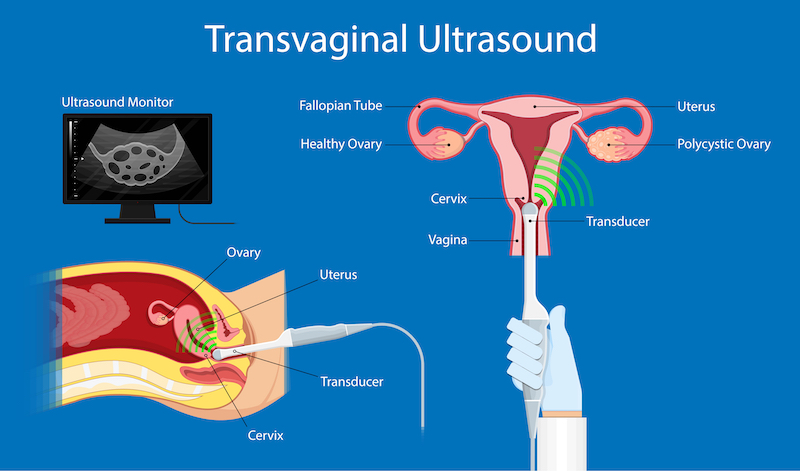 Diagram explaining how a transvaginal untrasound works (used to diagnose pcos)